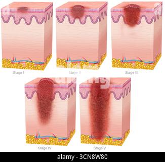 Illustrazione delle diverse fasi dello sviluppo del melanoma. Ci sono cinque stadi di melanoma, da 0 a IV, con numeri più alti che indicano una maggiore diffusione della malattia. Inoltre, alcuni stadi sono suddivisi in categorie A, B, C e D, dove le lettere indicano anche la progressione della malattia. Foto Stock