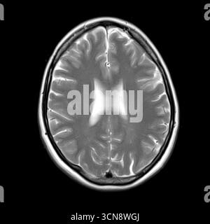 Scansione di risonanza magnetica (RM) che mostra ventricoli laterali normali, corpus calloso e materia bianca circostante senza anomalie visibili. Foto Stock