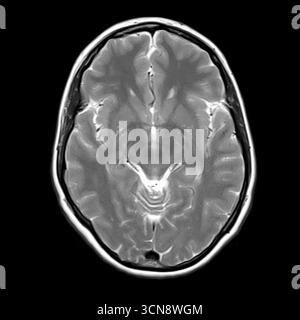 Scansione a risonanza magnetica (MRI) del cervello umano che mostra midbrain, lobi temporali e regione ippocampale. Nessuna patologia visibile, strutture simmetriche, ventricoli chiari. Foto Stock