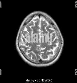 Scansione di risonanza magnetica (MRI) che mostra strutture cerebrali normali. Nessuna anomalia visibile. Segnale elevato nel liquido cerebrospinale (CSF) e solchi corticali trasparenti. Foto Stock