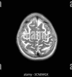 Scansione di risonanza magnetica (MRI) che mostra strutture cerebrali normali. Nessuna anomalia visibile. Segnale elevato nel liquido cerebrospinale (CSF) e solchi corticali trasparenti. Foto Stock