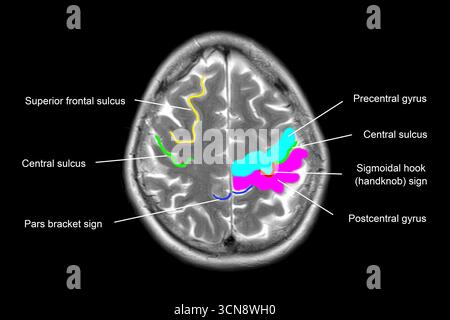 Scansione di risonanza magnetica (MRI) che mostra l'anatomia cerebrale normale con strutture principali etichettate. Foto Stock