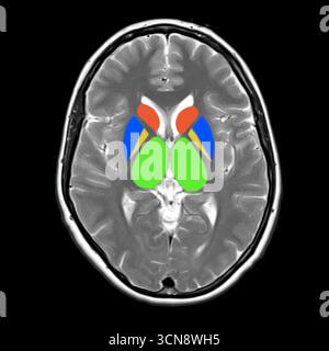 Scansione a risonanza magnetica (MRI) che mostra una normale anatomia cerebrale con gangli basali colorati (nucleo caudato in rosso, putamen in blu, globus pallidus in giallo) e thalami (verde). Foto Stock