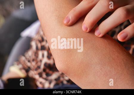 Primo piano del braccio umano con la placca bianca di cicatrice appuntita dal dito sulla superficie della pelle in luce naturale Foto Stock
