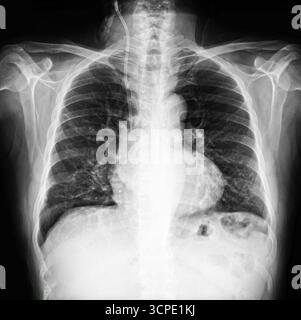 Radiografia del torace che mostra polmoni, colonna vertebrale e costole con dettagli di imaging medico. Articolazione della spalla, lesioni di tendini e ossa. Concetto di film sulla salute Foto Stock