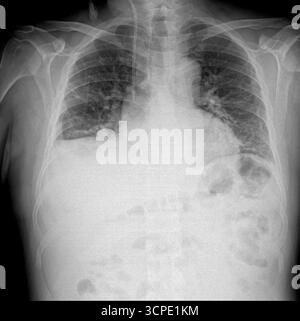 Radiografia del torace che mostra polmoni, colonna vertebrale e costole con dettagli di imaging medico. Articolazione della spalla, lesioni di tendini e ossa. Concetto di film sulla salute Foto Stock