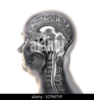 Immagine di una scansione a risonanza magnetica colorata (MRI) del cervello e del collo, che mostra l'anatomia del sistema nervoso centrale e la colonna cervicale. Foto Stock