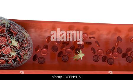 Immagine 3D della formazione di trombi all'interno di un vaso sanguigno Foto Stock