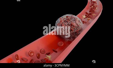 Immagine 3D della formazione di trombi all'interno di un vaso sanguigno Foto Stock