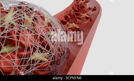 Immagine 3D della formazione di trombi all'interno di un vaso sanguigno Foto Stock
