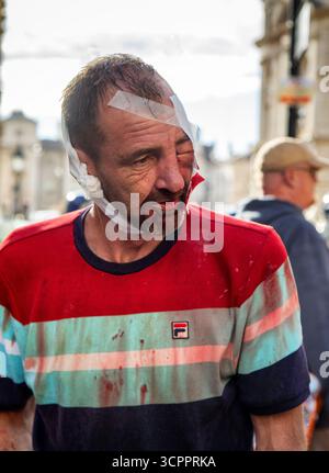 LONDRA, REGNO UNITO. 13 settembre 2025. Manifestante ferito alla marcia Unite the Kingdom. Whitehall. Foto di Ian Humphreys Foto Stock