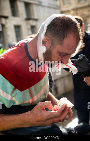 LONDRA, REGNO UNITO. 13 settembre 2025. Manifestante ferito alla marcia Unite the Kingdom. Whitehall. Foto di Ian Humphreys Foto Stock
