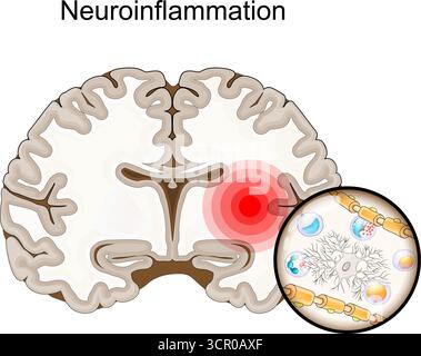 Neuroinfiammazione. Sezione trasversale del cervello umano con infiammazione. Primo piano di leucociti, microgliali, neuroni e infiltrazione di cellule immunitarie. CEN Illustrazione Vettoriale