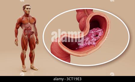 Illustrazione concettuale del cancro del colon in un uomo. Foto Stock
