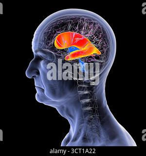 Illustrazione di ventricoli laterali ingrossati del cervello (idrocefalo) in una persona anziana. Foto Stock