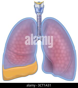 Illustrazione dei polmoni, uno dei quali influenzato dall'effusione pleurica (sinistra). Questo è l'accumulo di liquido nello spazio tra i polmoni e la parete toracica (lo spazio pleurico). Può essere causato da condizioni come infezioni, tumori, traumi, insufficienza cardiaca o malattie epatiche. I sintomi includono mancanza di respiro e dolore toracico, ma alcuni versamenti possono essere asintomatici. Foto Stock