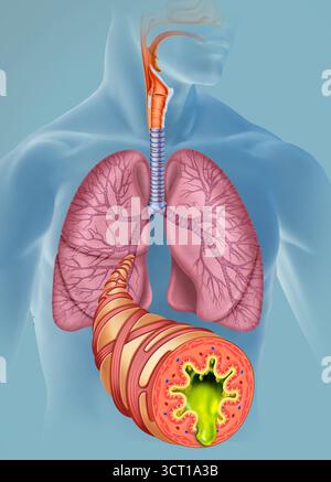 Illustrazione di una figura umana che mostra il sistema respiratorio, con le vie aeree infiammate evidenziate in primo piano. La bronchite acuta è un'infiammazione dei tubi bronchiali, comunemente causata da infezioni virali. I suoi sintomi includono tosse persistente, produzione di espettorato e difficoltà respiratorie. Foto Stock