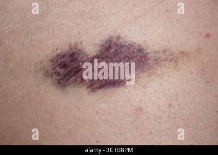 Ematoma. Livido sul corpo. Primo piano livido sul corpo. Primo piano su un livido. Violenza, vittima. Livido la consistenza della pelle ferita Foto Stock