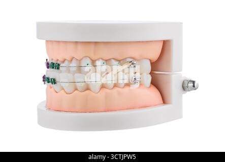 Modello ortodontico dentale con bretelle che mostrano staffe, fili e allineamento per lo studio Foto Stock