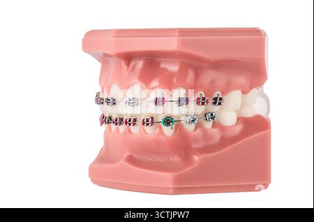 Modello ortodontico dentale con bretelle che mostrano staffe, fili e allineamento per lo studio Foto Stock