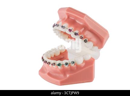 Modello ortodontico dentale con bretelle che mostrano staffe, fili e allineamento per lo studio Foto Stock