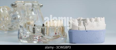 Vista dettagliata dei modelli di ganasce trasparenti e in gesso che mostrano impianti dentali e corone utilizzate per l'odontoiatria rigenerativa e per la formazione. Foto Stock
