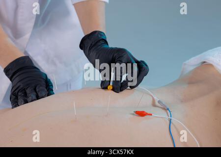 Il medico esegue l'elettroagopuntura sulla schiena, collegando aghi sterili alle derivazioni per alleviare il dolore e riabilitare in modo sicuro. Foto Stock