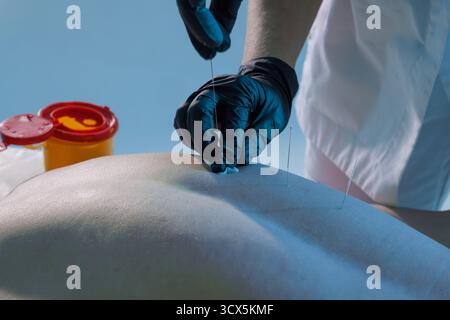 Vista ravvicinata dell'inserimento sterile dell'ago sulla schiena durante la terapia di agopuntura per alleviare il dolore e il recupero. Foto Stock