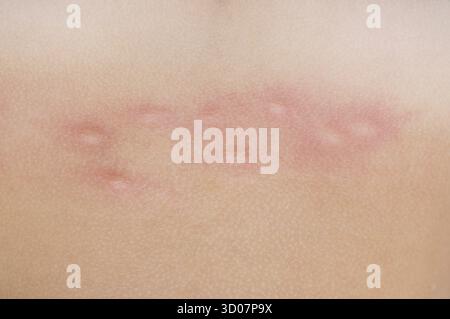 Primo piano di molte punture di zanzare sulla pelle umana Foto Stock