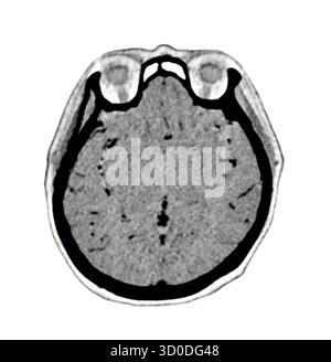 Una scansione TC chiara e in bianco e nero che mostra la struttura normale del cervello, evidenziando i bordi distinti e l'assenza di anomalie. Foto Stock