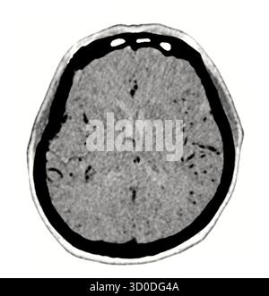Una scansione TC chiara e in bianco e nero che mostra la struttura normale del cervello, evidenziando i bordi distinti e l'assenza di anomalie. Foto Stock