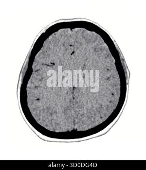 Una scansione TC chiara e in bianco e nero che mostra la struttura normale del cervello, evidenziando i bordi distinti e l'assenza di anomalie. Foto Stock