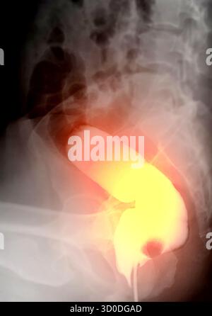 Immagine diagnostica dell'enema del bario che mostra la presenza di diverticolosi nel colon trasversale e ascendente, dimostrando la tipica f diverticolare Foto Stock