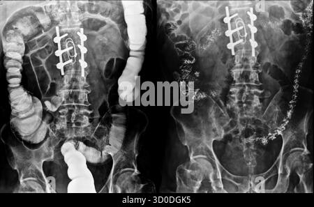 Enema bario a doppio contrasto che mostra una lieve scoliosi nella colonna lombare e alcuni diverticoli nel colon destro. Non ci sono segni di intestino Foto Stock