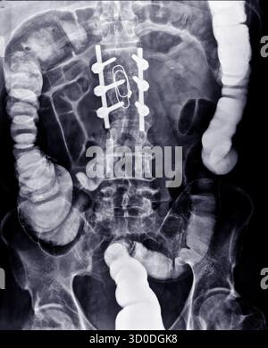 Enema bario a doppio contrasto che mostra una lieve scoliosi nella colonna lombare e alcuni diverticoli nel colon destro. Non ci sono segni di intestino Foto Stock