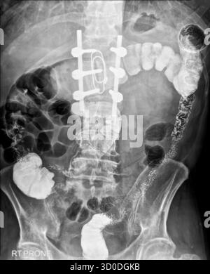 Enema bario a doppio contrasto che mostra una lieve scoliosi nella colonna lombare e alcuni diverticoli nel colon destro. Non ci sono segni di intestino Foto Stock