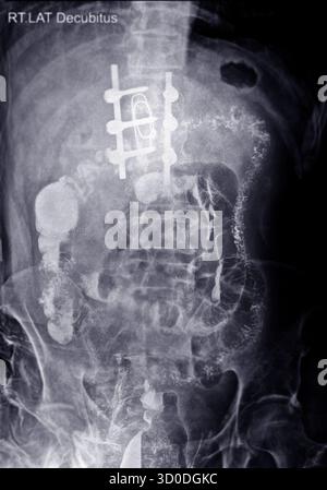 Enema bario a doppio contrasto che mostra una lieve scoliosi nella colonna lombare e alcuni diverticoli nel colon destro. Non ci sono segni di intestino Foto Stock