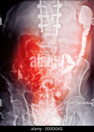 Enema bario a doppio contrasto che mostra una lieve scoliosi nella colonna lombare e alcuni diverticoli nel colon destro. Non ci sono segni di intestino Foto Stock
