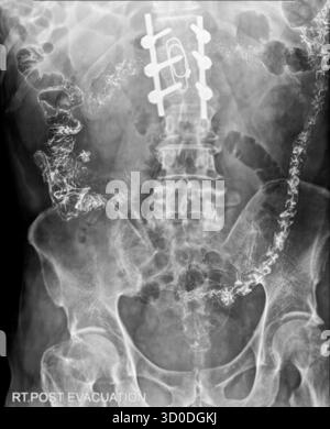 Enema bario a doppio contrasto che mostra una lieve scoliosi nella colonna lombare e alcuni diverticoli nel colon destro. Non ci sono segni di intestino Foto Stock