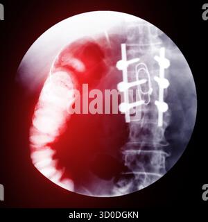 Enema bario a doppio contrasto che mostra una lieve scoliosi nella colonna lombare e alcuni diverticoli nel colon destro. Non ci sono segni di intestino Foto Stock