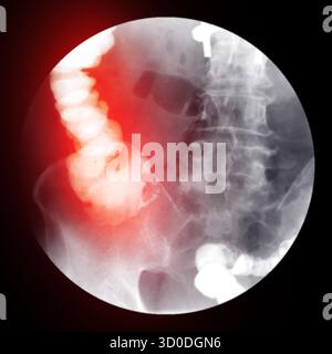 Enema bario a doppio contrasto che mostra una lieve scoliosi nella colonna lombare e alcuni diverticoli nel colon destro. Non ci sono segni di intestino Foto Stock