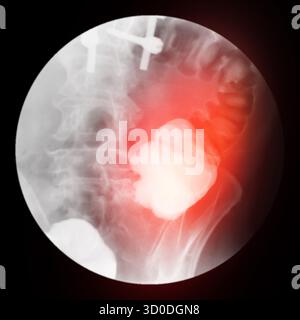 Enema bario a doppio contrasto che mostra una lieve scoliosi nella colonna lombare e alcuni diverticoli nel colon destro. Non ci sono segni di intestino Foto Stock