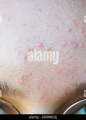 Primo piano della pelle della fronte umana che mostra acne, rossore e pori visibili, illustrando condizioni cutanee comuni e preoccupazioni dermatologiche. Foto Stock
