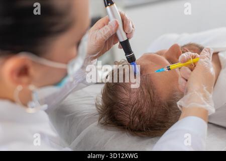 Alopecia. Perdita di capelli uomo migliorare la rigenerazione del trattamento di crescita, dermapen microneedling, vitamine esosomi iniezioni di plasma. Cosmetologo tricologo medico procedura cuoio capelluto mesoterapia frazionaria Foto Stock