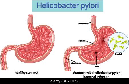 Illustrazione vettoriale che mostra lo stomaco sano contro lo stomaco ulcerato infettato da batteri Helicobacter pylori Illustrazione Vettoriale