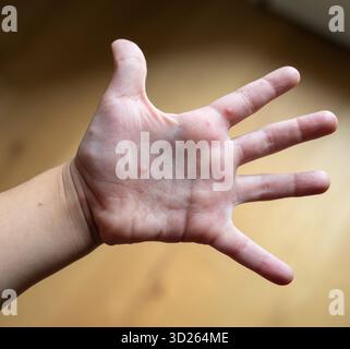 Mano del bambino che mostra la mano, l'afta epizootica e la bocca eruzione cutanea con piccoli dossi rossastri multipli e vesciche sul palmo, sintomo dermatologico pediatrico di infezione virale Foto Stock