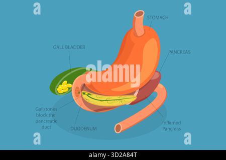 Illustrazione concettuale piatta isometrica 3D di pancreatite acuta, problemi del sistema digestivo illustrazione concettuale piatta isometrica 3D di pancreatite acuta, problemi del sistema digestivo Foto Stock