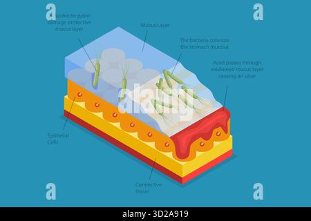 Illustrazione concettuale isometrica piatta 3D di ulcera peptica, disturbo del tratto digerente illustrazione concettuale isometrica piatta 3D di ulcera peptica, disturbo del tratto digerente Foto Stock