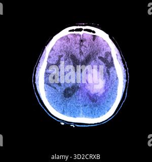 Tomografia computerizzata a colori (TC) del cervello di un paziente che ha avuto un ictus. L'ictus, o incidente cerebrovascolare (CVA), è stato causato da un'emorragia (sanguinamento) nei gangli basali sinistri. Foto Stock