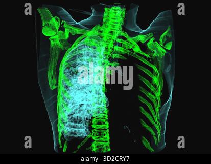 Tomografia computerizzata (TC) 3D colorata di un paziente con un polmone sinistro senza aria in esso a causa di un carcinoma. Foto Stock